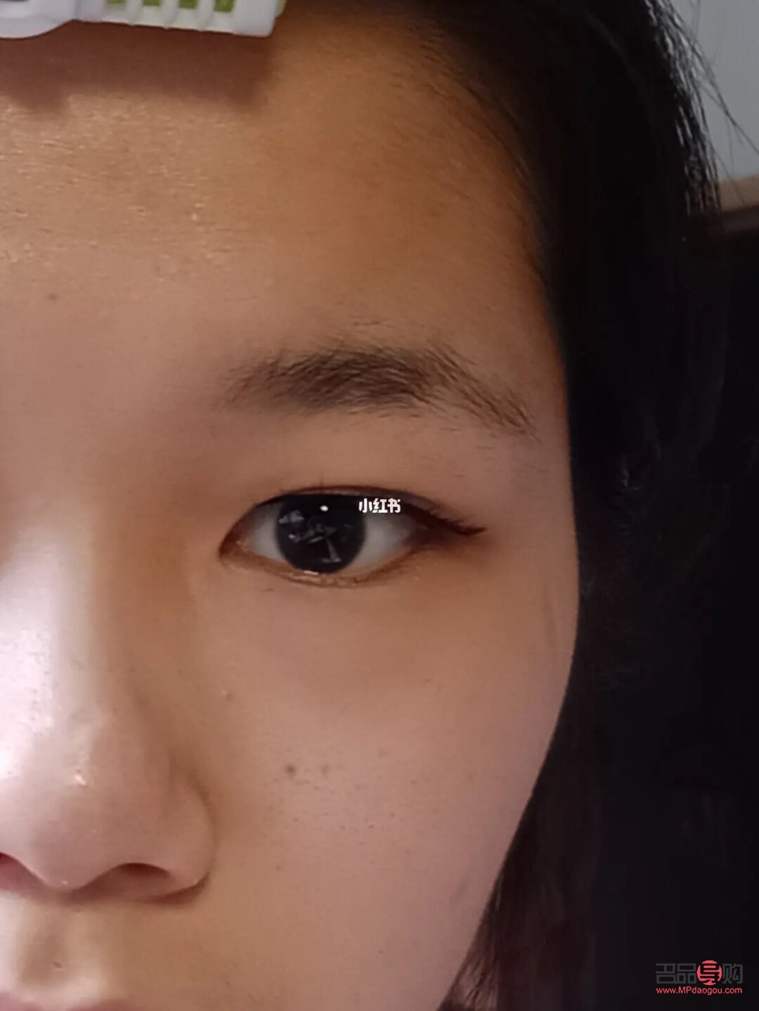 <h3>解決單眼皮腫眼泡的有效方法</h3>