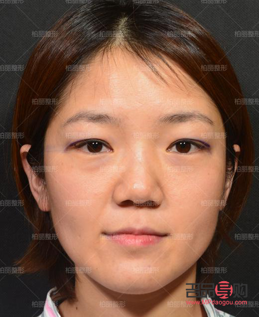 <h3>腫眼泡埋線雙眼皮效果能持續(xù)多久？</h3>