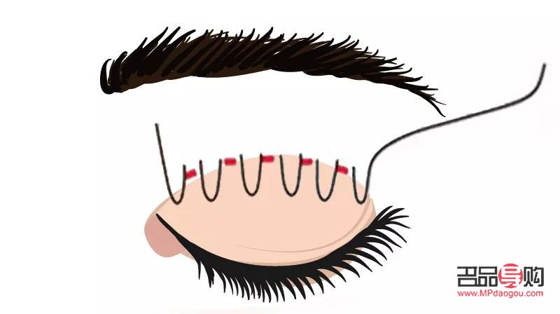 <h3>腫眼泡埋線雙眼皮效果能持續(xù)多久？</h3>