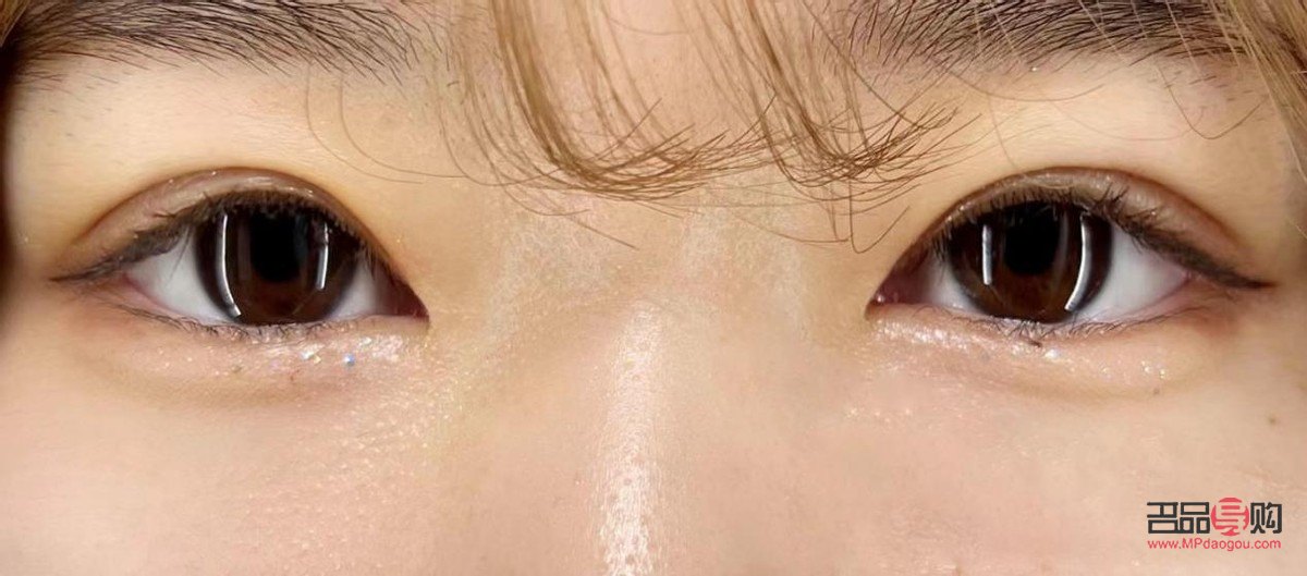 腫眼泡埋線雙眼皮效果能持續(xù)多久？