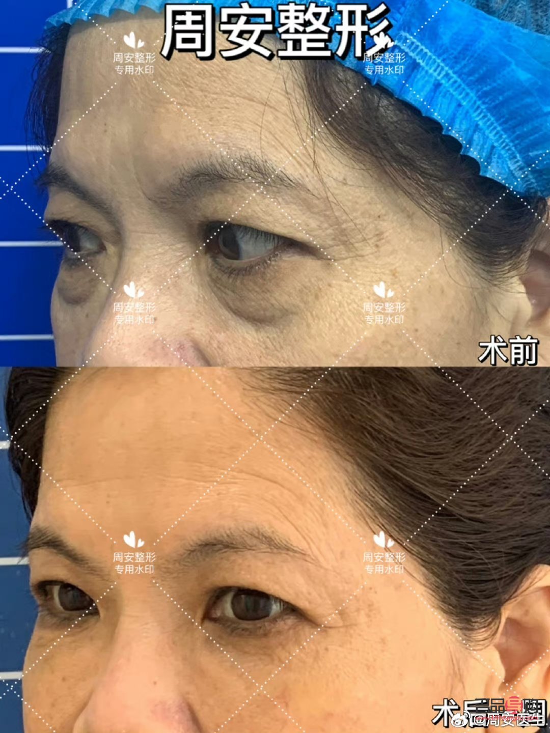 <h3>眼袋問題：非手術解決方案探討</h3>