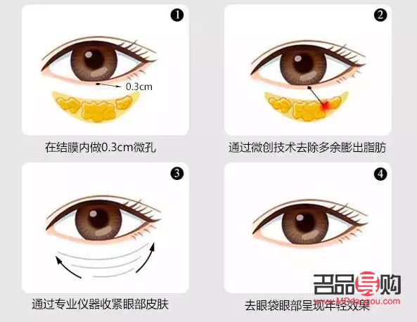 <h3>眼袋問題：非手術解決方案探討</h3>