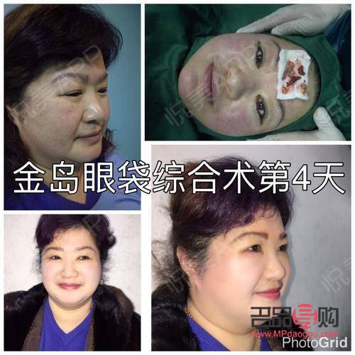 眼袋問(wèn)題：非手術(shù)解決方案探討