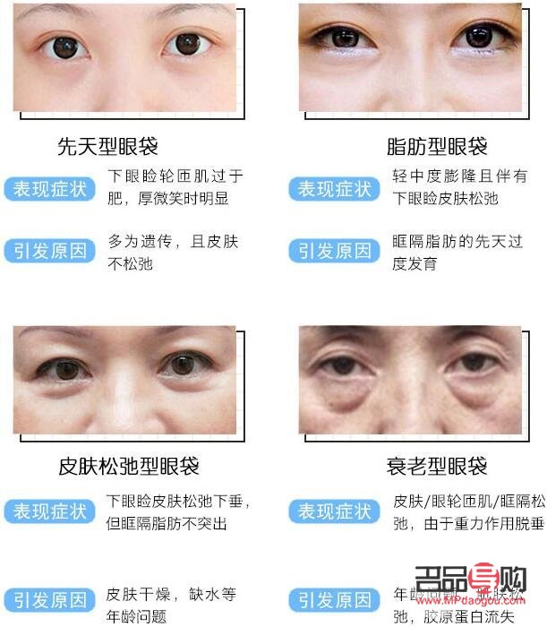 眼袋貼去眼袋有用嗎(眼袋貼去眼袋有用嗎多少錢)