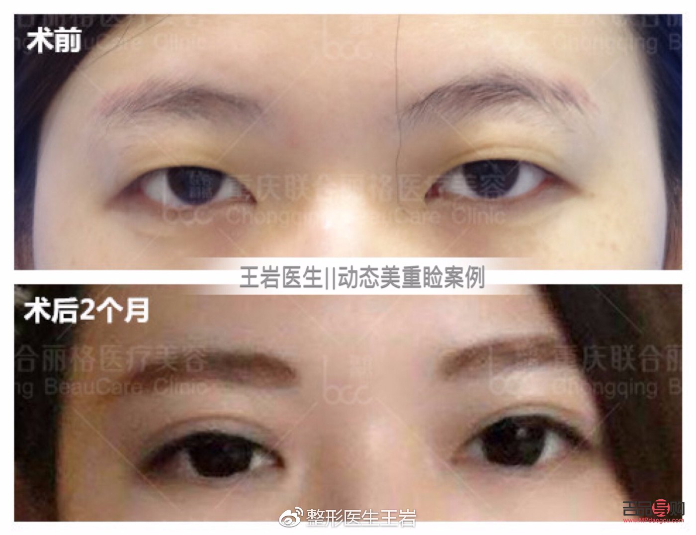 <h3>腫眼泡與非腫眼泡：眼部狀態(tài)對比與解析</h3>