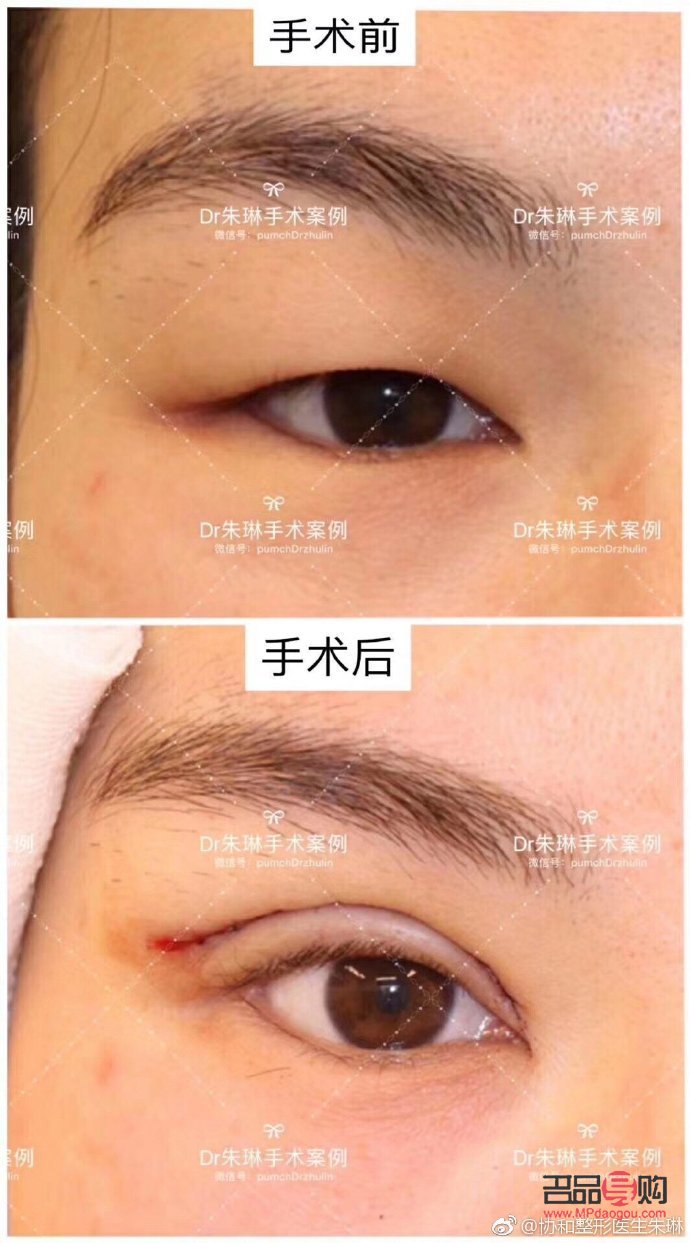 <h3>腫眼泡與非腫眼泡：眼部狀態(tài)對比與解析</h3>