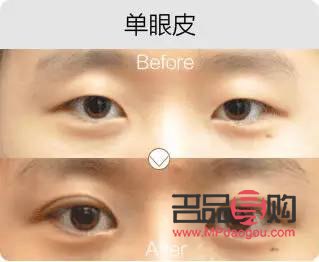 <h3>歐式大寬雙眼皮：魅力之眼的新風(fēng)尚</h3>