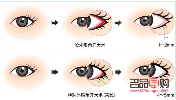 開外眼角手術(shù)過程圖(開外眼角手術(shù)過程圖片)