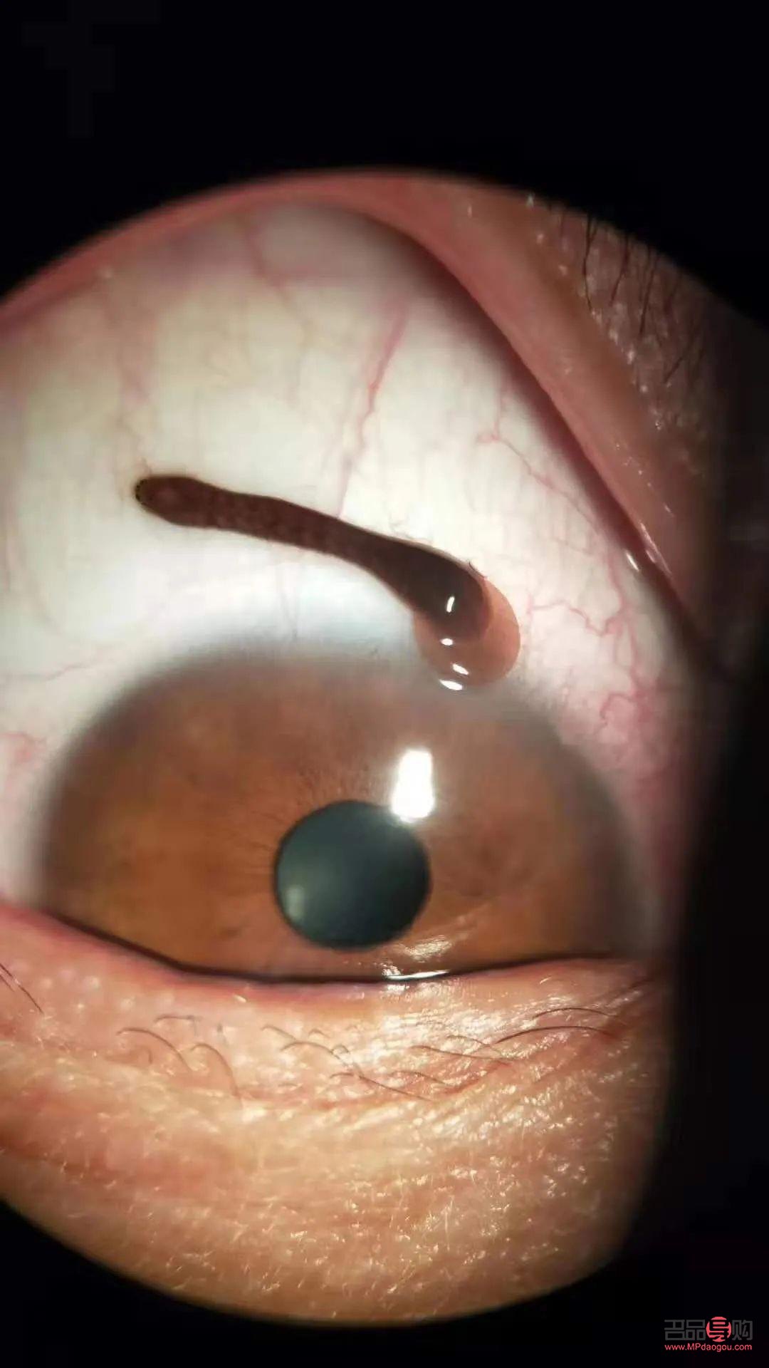 <h3>眼睛異物能否自行排出？</h3>