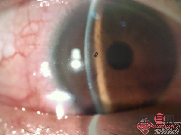 <h3>眼睛異物能否自行排出？</h3>