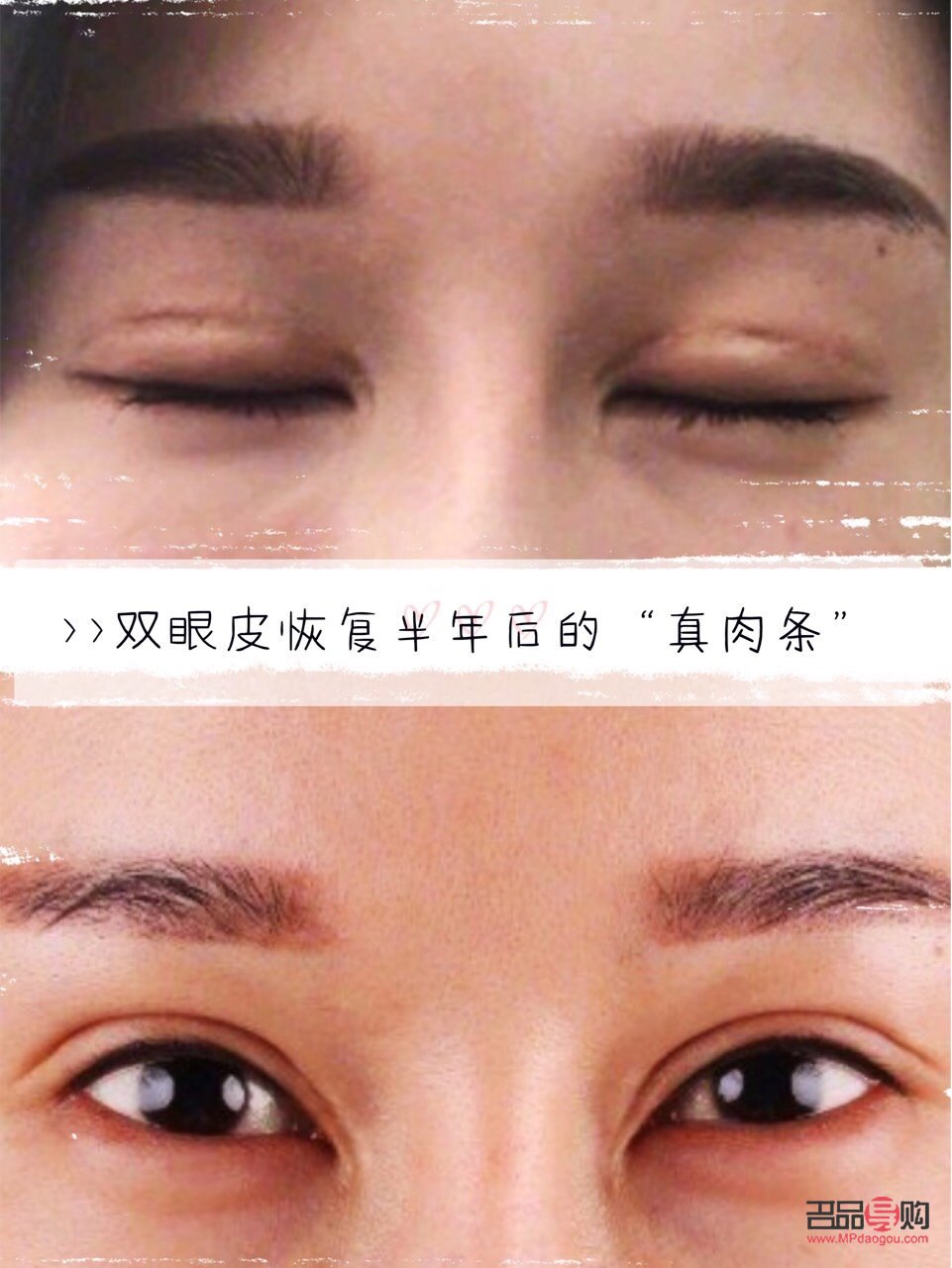 雙眼皮肉條感怎么修復(fù)(雙眼皮有肉條感怎么修復(fù))