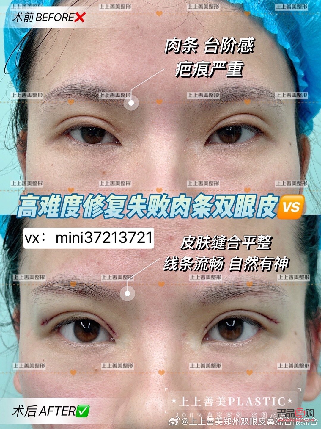 雙眼皮肉條感怎么修復(fù)(雙眼皮有肉條感怎么修復(fù))