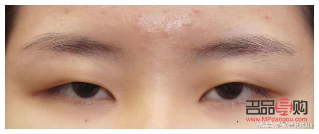 單眼皮眼睛下垂怎么辦(單眼皮眼睛下垂怎么辦圖片)