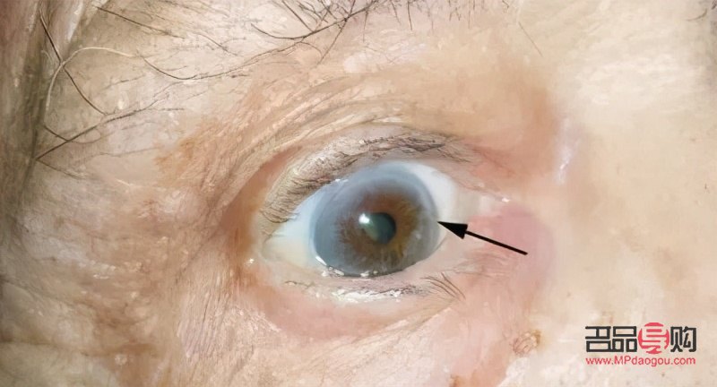 眼皮下垂怎么自然恢復(fù)(眼皮下垂怎么自然恢復(fù)小妙招)