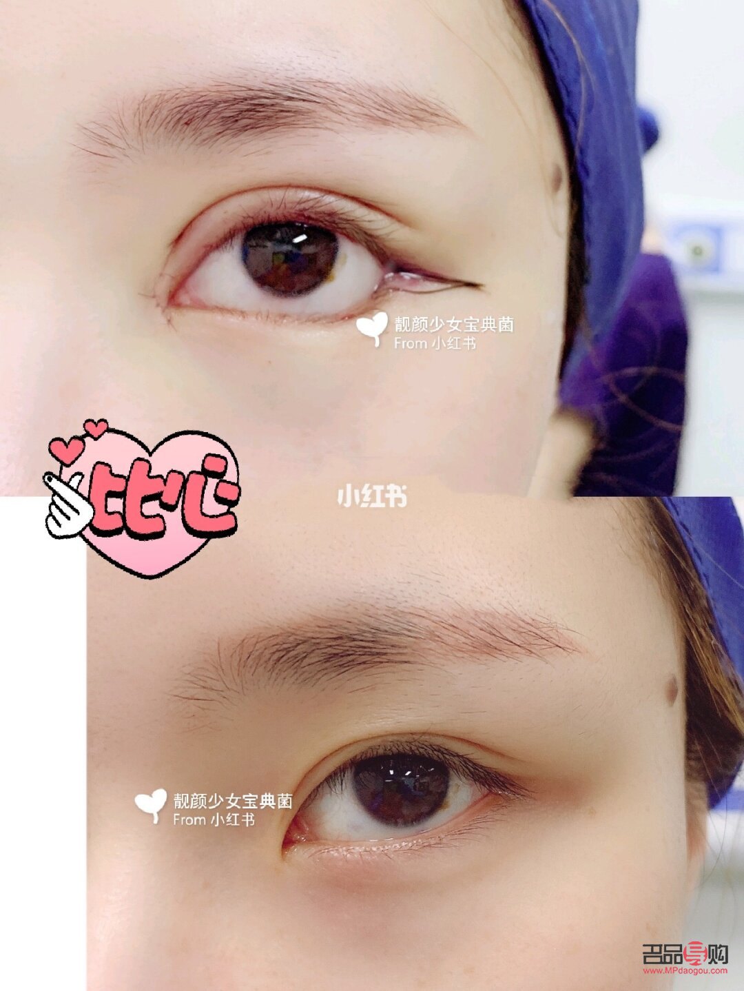 雙眼皮下至有必要嗎(雙眼皮下至有必要做嗎)