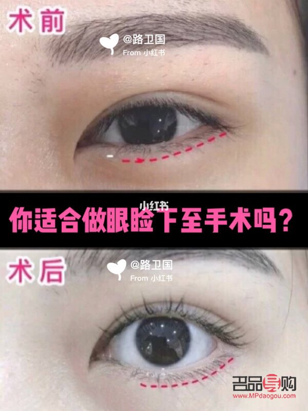 雙眼皮下至有必要嗎(雙眼皮下至有必要做嗎)