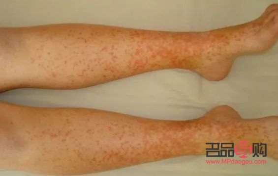 成人低燒怎么護理身體(成人低燒怎么護理身體呢)