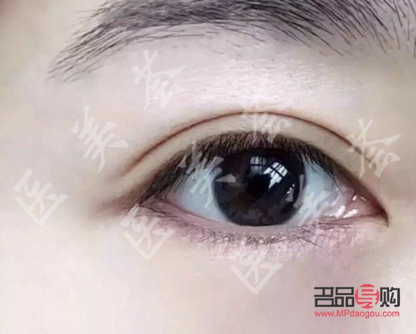 內(nèi)雙眼皮外雙眼皮區(qū)別圖片(內(nèi)雙眼皮外雙眼皮區(qū)別圖片女)