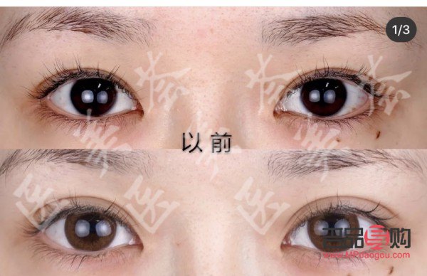 內(nèi)雙眼皮外雙眼皮區(qū)別圖片(內(nèi)雙眼皮外雙眼皮區(qū)別圖片女)