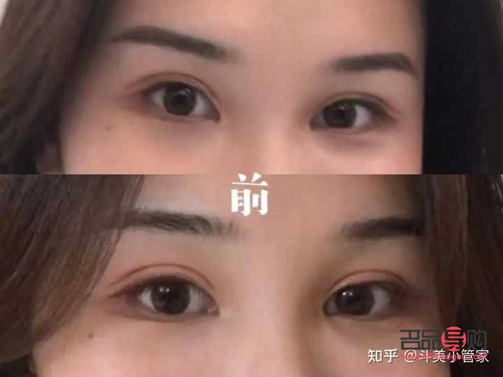 割雙眼皮最好的是什么季節(jié)(割雙眼皮哪個(gè)季節(jié)割恢復(fù)的最快)