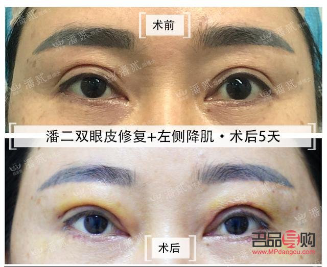 割雙眼皮發(fā)黃說(shuō)明快好了嗎(割雙眼皮發(fā)黃說(shuō)明快好了嗎圖片)
