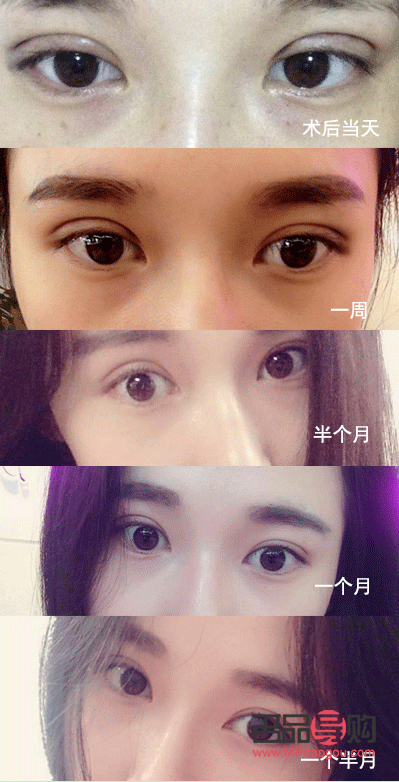 <h3>全切雙眼皮1個月恢復(fù)圖詳解</h3>