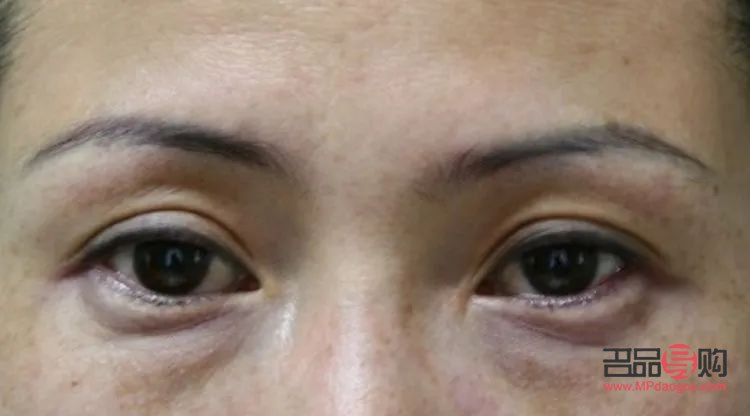 眼輪匝肌肥厚型眼袋怎么形成的(眼輪匝肌肥厚型眼袋怎么去除)