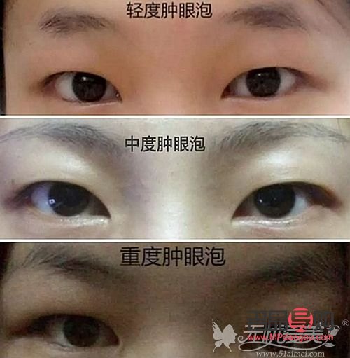 腫眼泡手術(shù)價格(腫眼泡手術(shù)價格是多少)