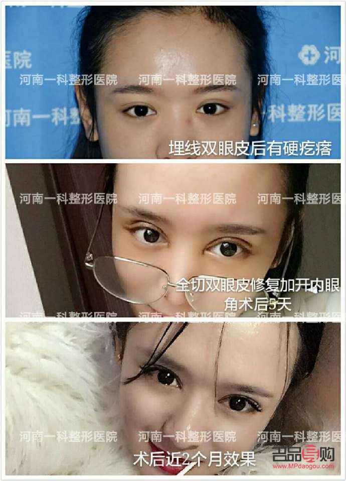 <h3>做個雙眼皮多少價錢？了解雙眼皮手術費用及考量因素</h3>