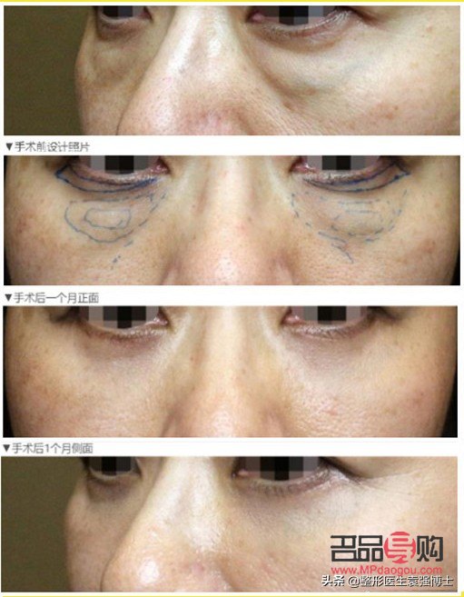 <h3>手術(shù)去眼袋，眼部健康會(huì)受影響嗎？</h3>