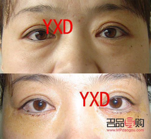 <h3>手術(shù)去眼袋，眼部健康會(huì)受影響嗎？</h3>