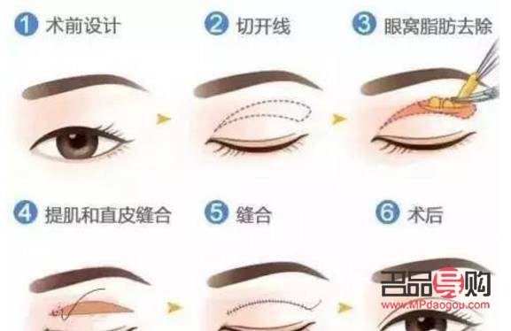 雙眼皮松弛下垂最好解決方法(雙眼皮松弛下垂最好解決方法做手術(shù)會(huì)難看嗎)