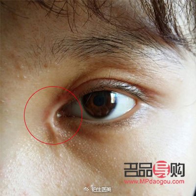 內(nèi)眼角開太大圖片(內(nèi)眼角開大了會有什么問題)