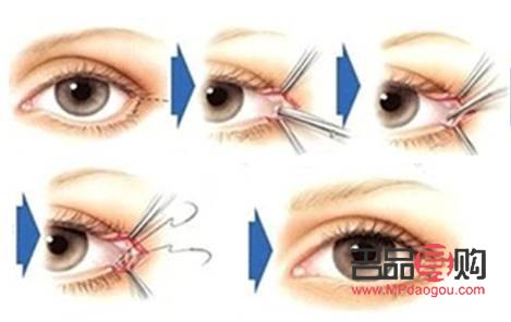 內(nèi)眼角開太大圖片(內(nèi)眼角開大了會有什么問題)
