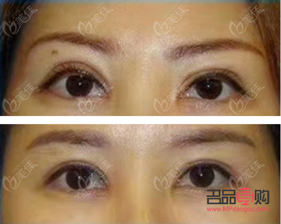 西安市做雙眼皮哪家好(西安市做雙眼皮哪家好一點)