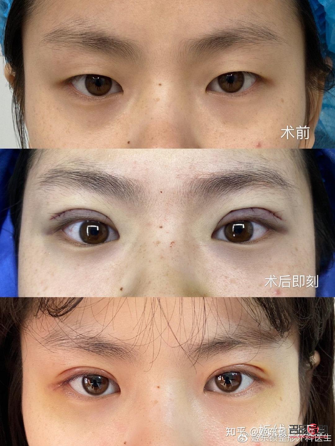 全切雙眼皮會(huì)越來(lái)越窄嗎(全切雙眼皮會(huì)越來(lái)越窄嗎?多久可以定型)