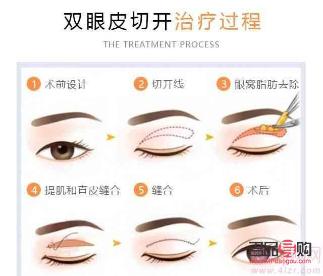 全切雙眼皮會(huì)越來(lái)越窄嗎(全切雙眼皮會(huì)越來(lái)越窄嗎?多久可以定型)