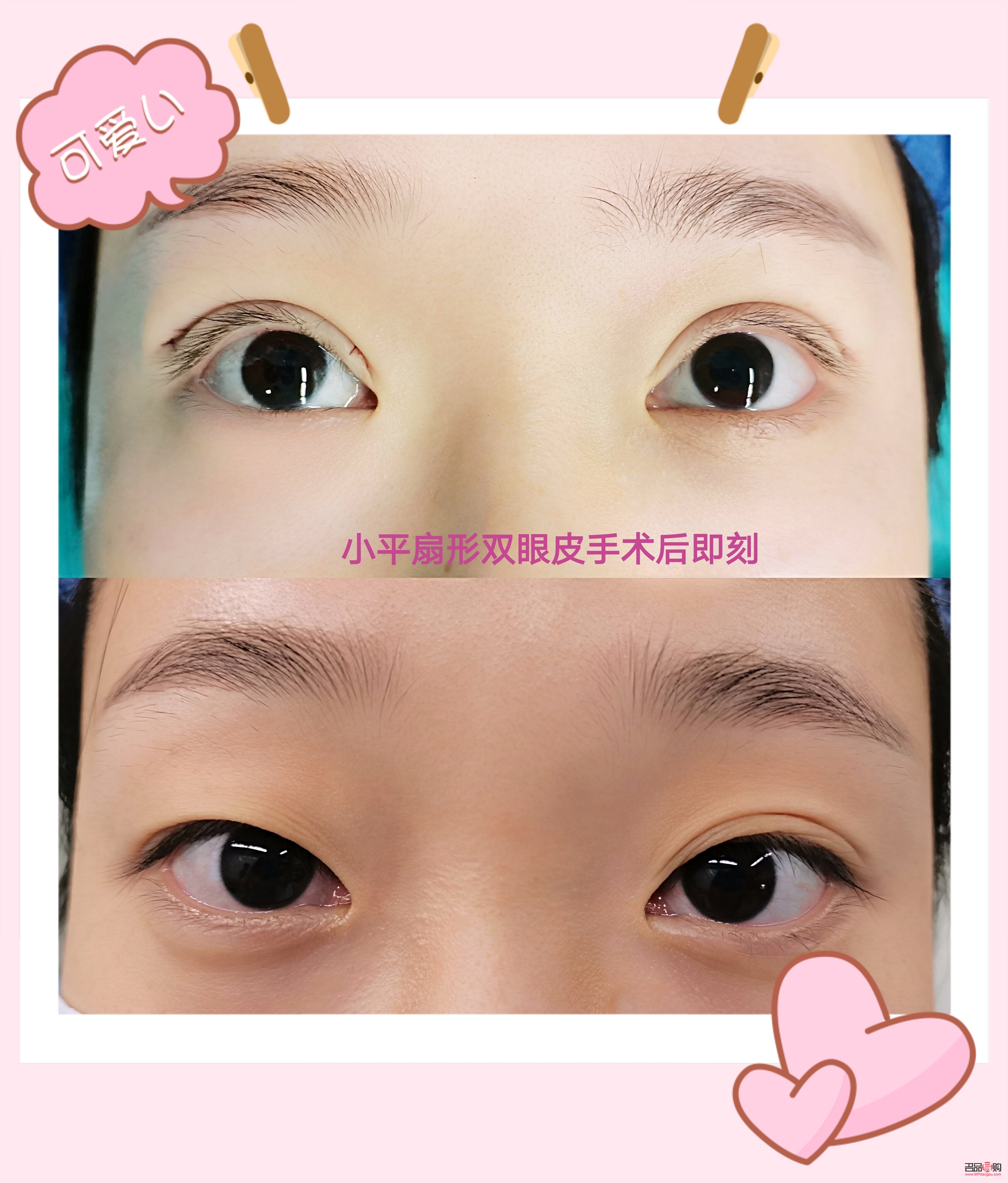 平扇雙眼皮顯年輕嗎(平扇雙眼皮顯年輕嗎女生)