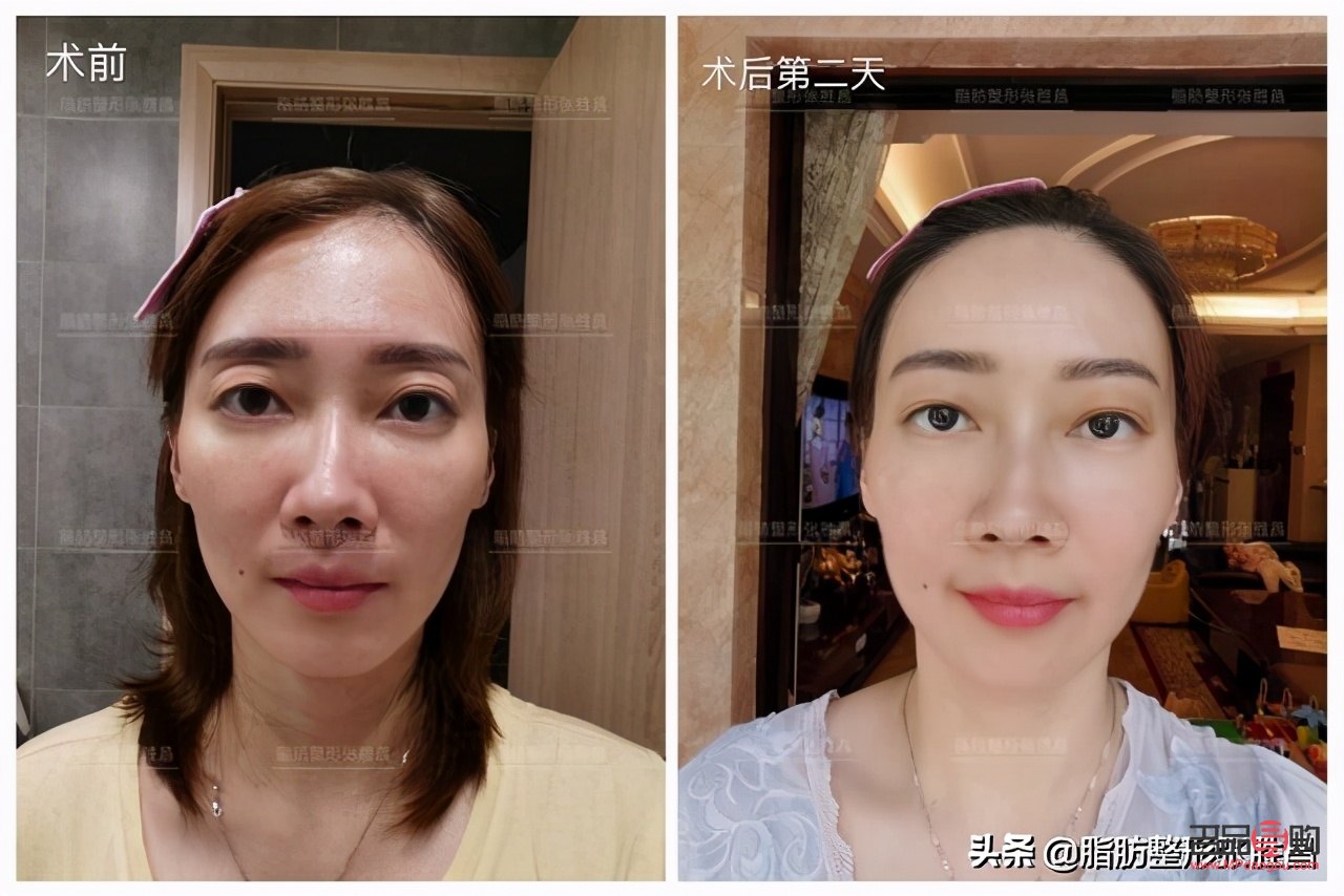 眼窩凹陷用什么填充最好(眼窩凹陷用什么填充最好多少錢)