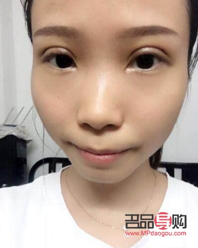 全切雙眼皮手術(shù)的后遺癥風(fēng)險(xiǎn)