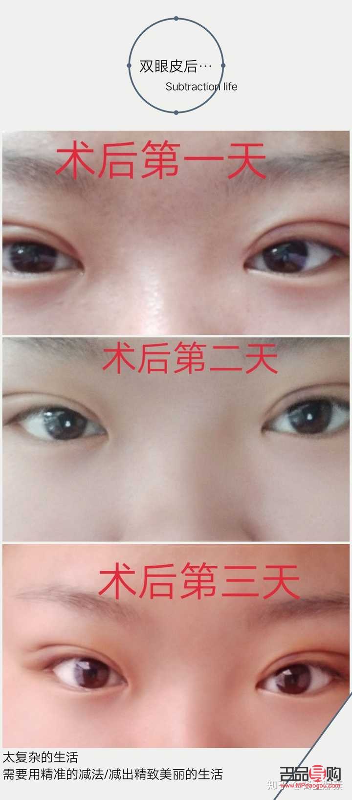 雙眼皮提拉手術(shù)可以保持幾年(雙眼皮提拉手術(shù)可以保持幾年嗎)