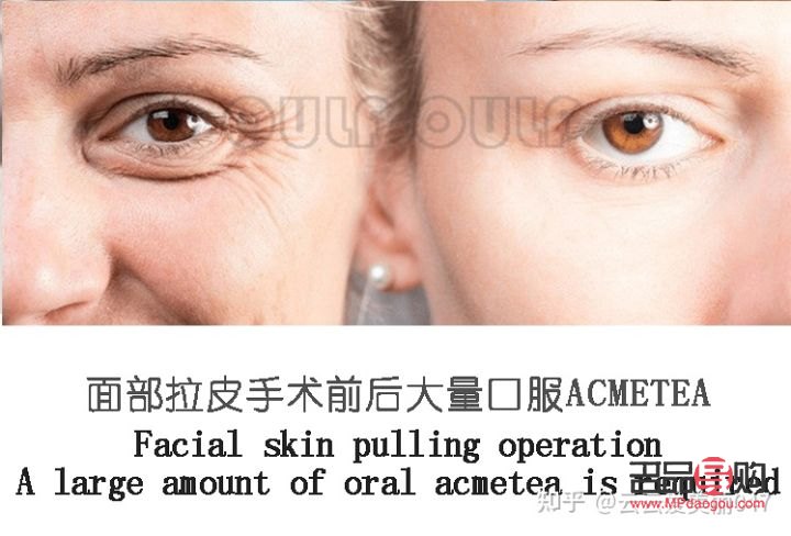 雙眼皮提拉手術(shù)可以保持幾年(雙眼皮提拉手術(shù)可以保持幾年嗎)