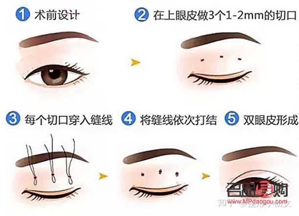 怎樣讓內(nèi)雙眼皮變成外雙眼皮(怎樣讓內(nèi)雙眼皮變成外雙眼皮呢)