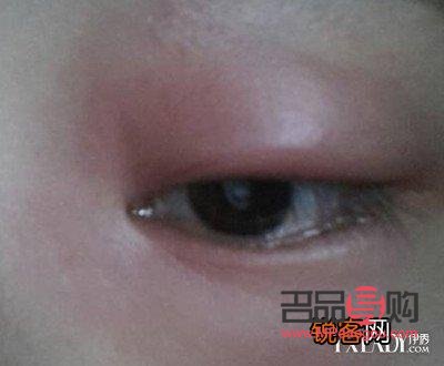 <h3>下眼袋浮腫原因及應(yīng)對：蚊子包般的眼部問題解析</h3>