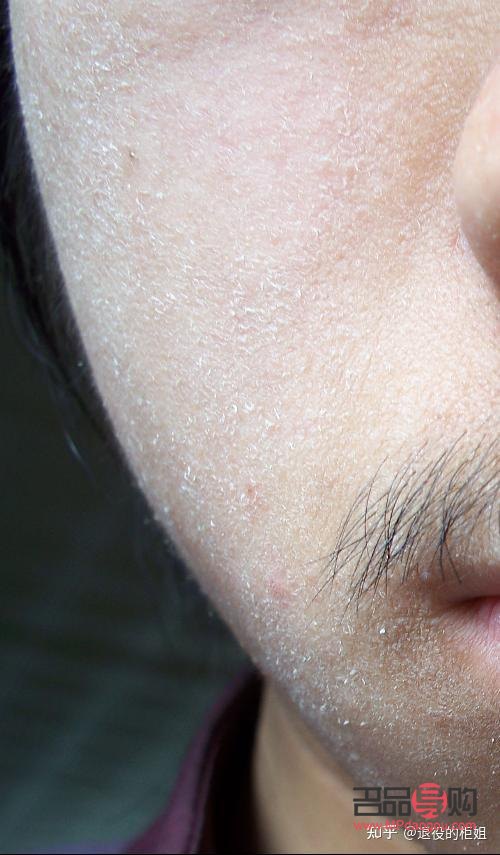 <h3>身體干燥起皮，呵護肌膚有妙招</h3>