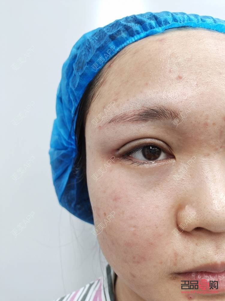 埋線與全切雙眼皮：選擇之美