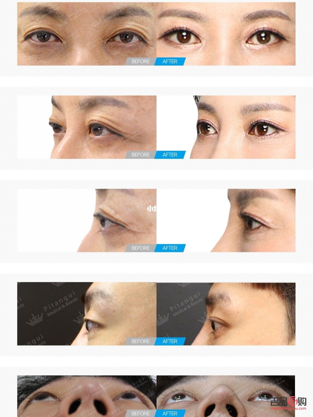 <h3>近視凸眼能否壓回去？專業(yè)解析與改善建議</h3>