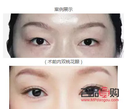 做什么樣的雙眼皮比較好(做什么樣的雙眼皮比較好看)