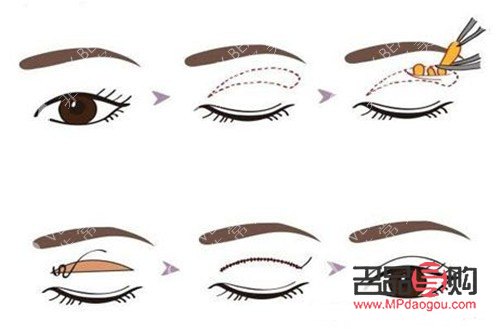 全切雙眼皮示意圖(全切雙眼皮示意圖全過(guò)程)