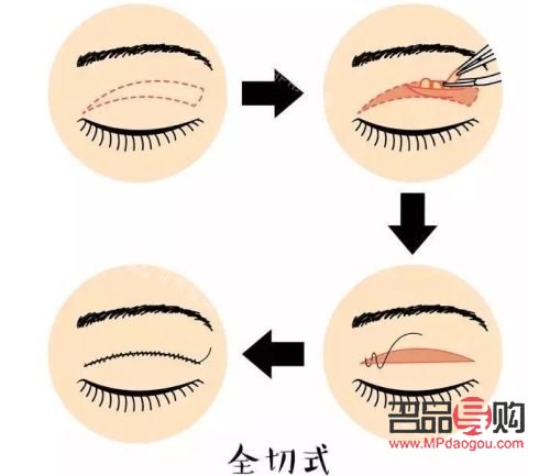 全切雙眼皮示意圖(全切雙眼皮示意圖全過(guò)程)